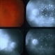 Choroiditis Choroiditis